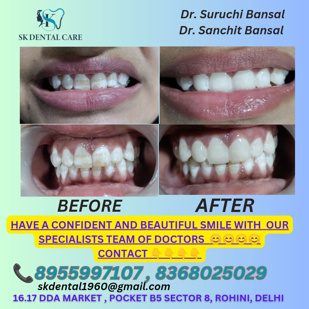 Smile Designing Treatment